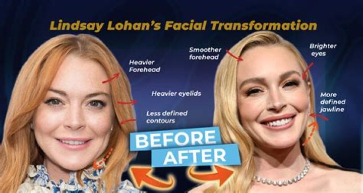 Did Lindsay Lohan's Appearance Transform Through Surgery?