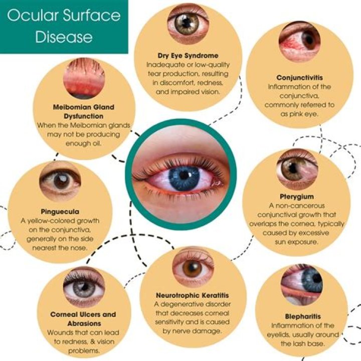 Does Ian Mcshane Have A Glass Eye? Actor Eye Related Injury And Condition Described |